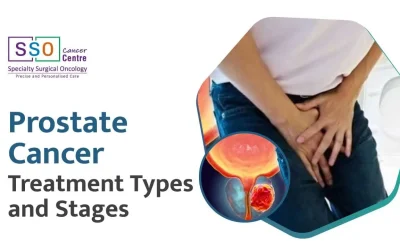 Prostate Cancer Treatment: Types, Options, and Side Effects